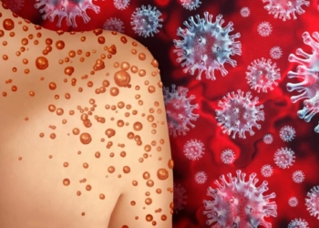 Deux-Sèvres. Des cas de variole du singe détectés dans le département