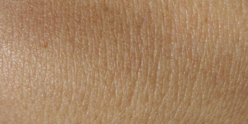 29 juin à Saumur. Cancer de la peau : Cette mutuelle propose un dépistage gratuit du mélanome